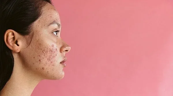 5 Acne Causing Foods to Avoid for Clear Skin India