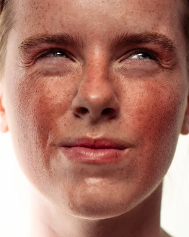 Are there any comorbidities associated with rosacea?