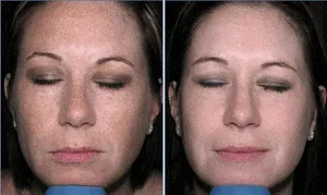 Buy Lytera System + Vitalize Peel!