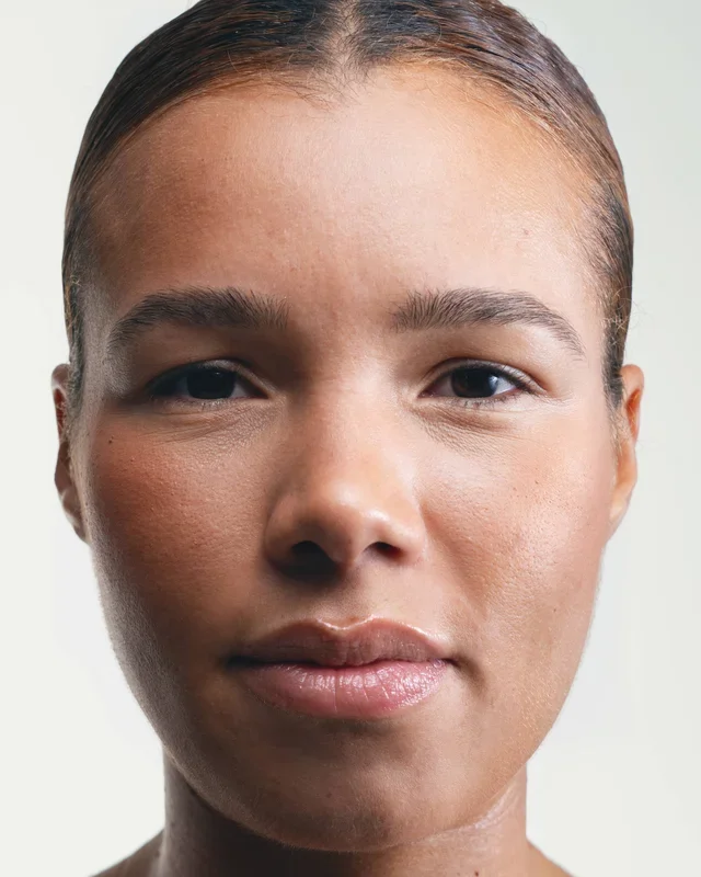 Fibrous Papule: How to Eliminate it?