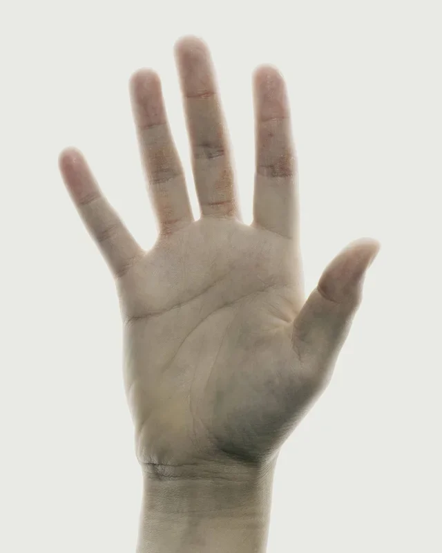 Hand Eczema: What is HECSI?