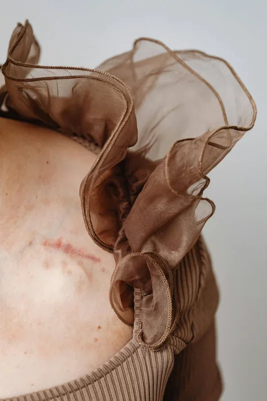Hyaluronic Acid: Effects on Scars?