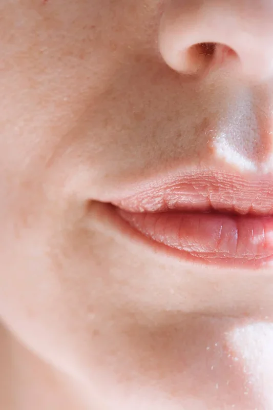 Lip Psoriasis: What is it?