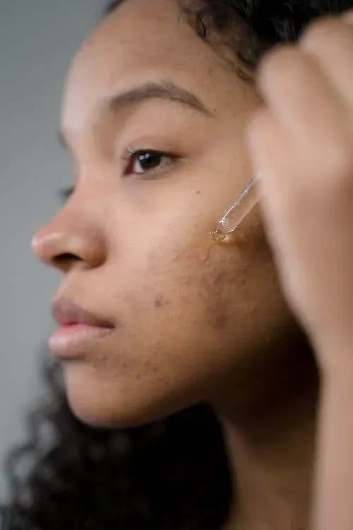 Moringa oil, a natural solution against acne?