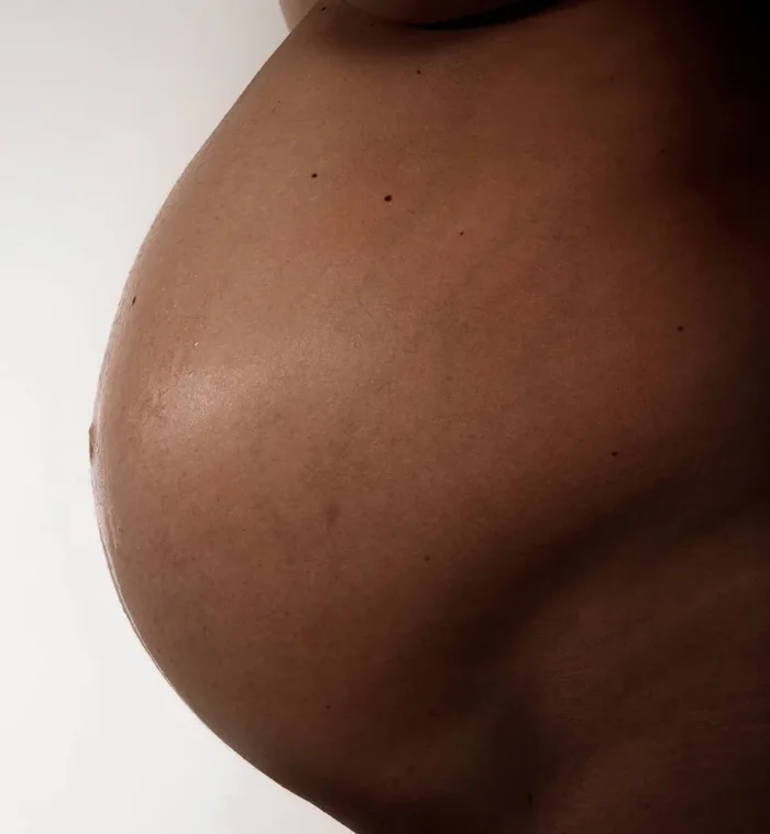 Psoriasis and Pregnancy: Are They Compatible?
