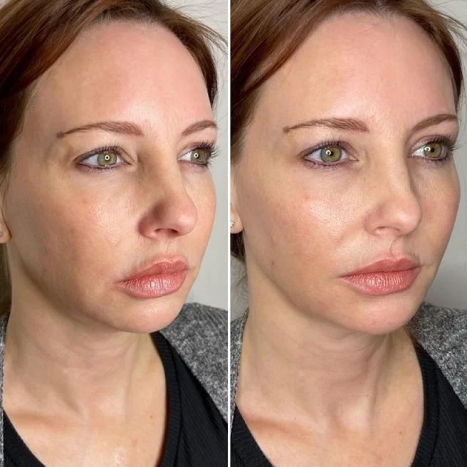 Restylane LYFT Syringe