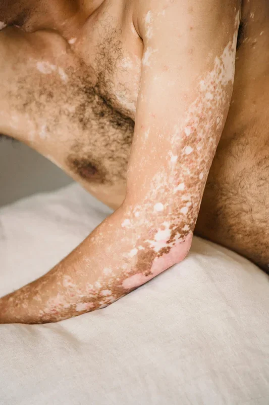 Segmental or Nonsegmental Vitiligo: The Differences.