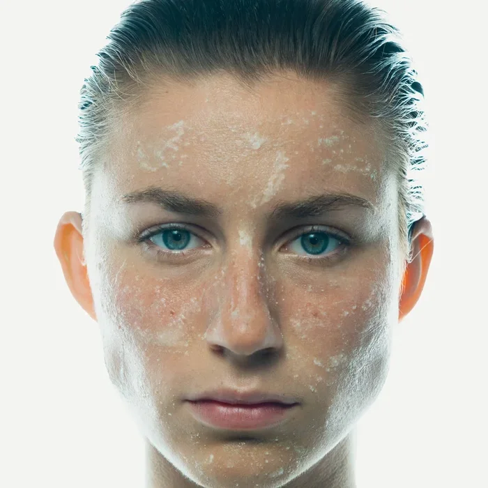 Skin purging: Tips for taking care of the skin.