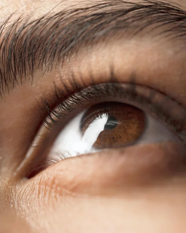 The Effect of Tranexamic Acid Against Dark Circles.