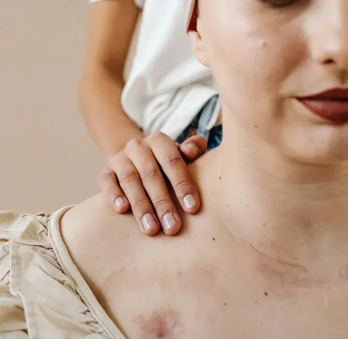 The effects of Italian Helichrysum against bruises?