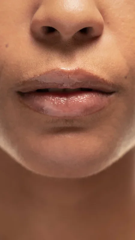 Upper Lip Lift: What Is It?