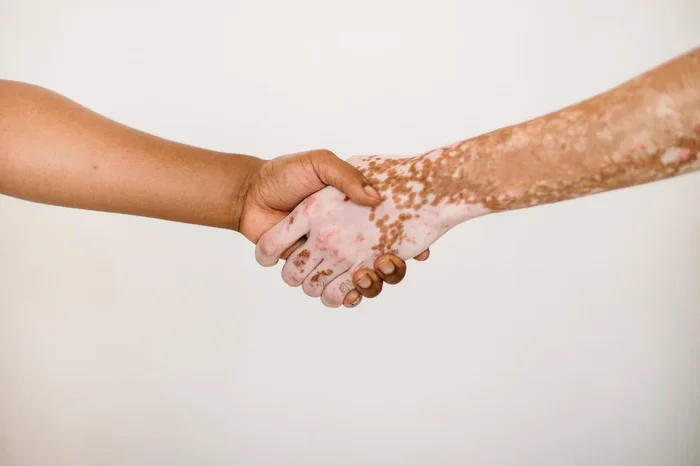 Understanding vitiligo in depth.