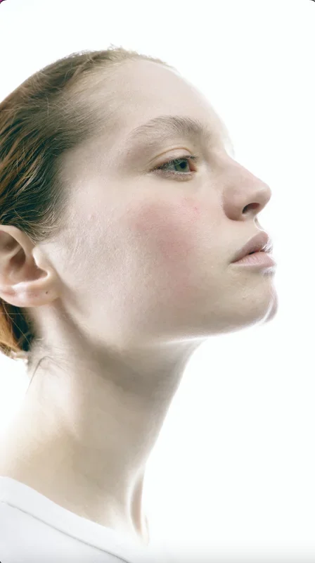 What is the potential progression of rosacea?